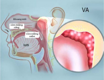 Nạo VA bằng dao plasma